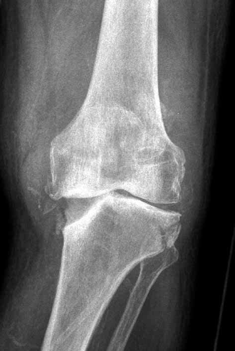 Radiograph Of The Knee Showing Resorption Of The Medial Tibial Condyle
