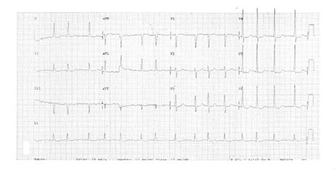 ECG fibrilação atrial e sobrecarga ventricular esquerda Download Scientific Diagram