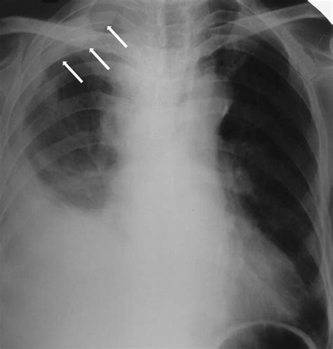 Pleural Tuberculosis Presented As Multiple Pleural Masses An Atypical