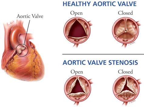 Aortic Valve Disease Causes Symptoms Exercises And Treatment