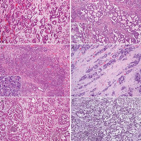 Renal Medullary Carcinoma In Nephrectomy Specimens Showed Download