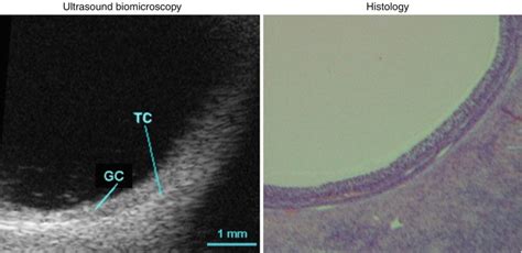 Ultrasound In Follicle Monitoring For Ovulation Inductioniui