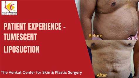 Patient Experience Tumescent Liposuction At Venkat Center Youtube