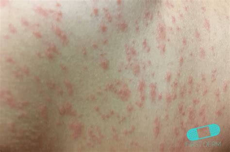 Because treatment options are limited. Spots and Rashes Caused by Viruses - Online Dermatology