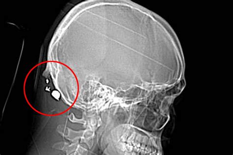 X Ray Shows Bullet Lodged In Mans Head After Random Shooting In