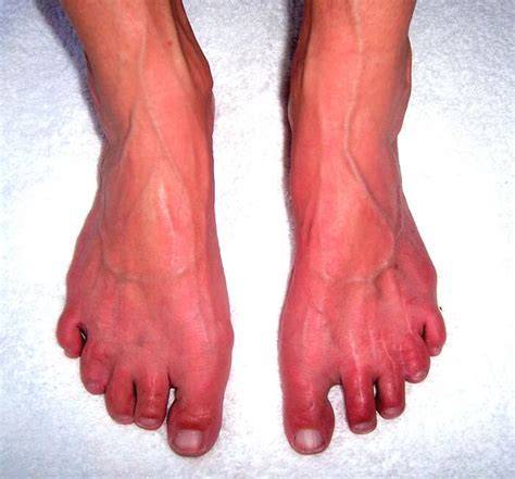Erythromelalgia Definition Symptoms Treatment And Causes Scope Heal