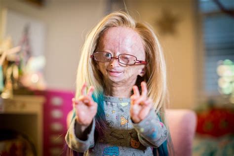 Adalia Rose A Disability Advocate And Youtuber Has Died She Was 15
