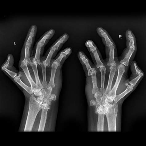 The Radiographic Hallmarks Of Rheumatoid Arthritis Are Soft Tissue