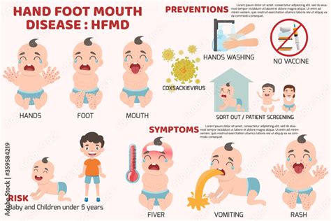 Hfmd Children Infected Poster Detail Of Hand Foot Mouth Disease