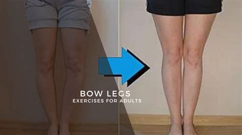 Bow Legs Correction Exercises For Adults Find Health Tips