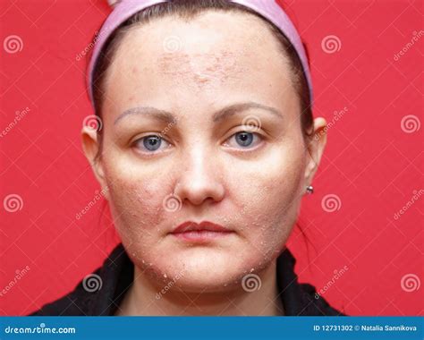 Skin Woman Peeling Stock Photo Image Of Cosmetology 12731302