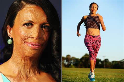 Burn Victims Amazing Recovery After Freak Wildfire During Marathon