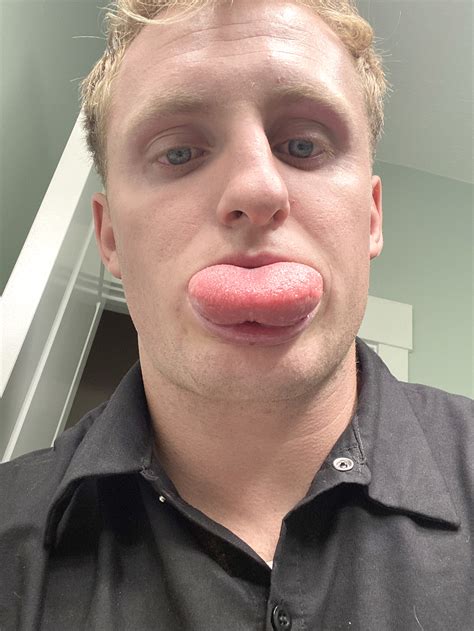 Man Films His Massively Swollen Tongue After He Was Stung By A Bee