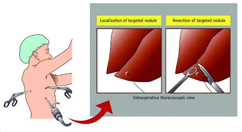 Video Assisted Thoracoscopic Surgery After Localization Using Download Scientific Diagram