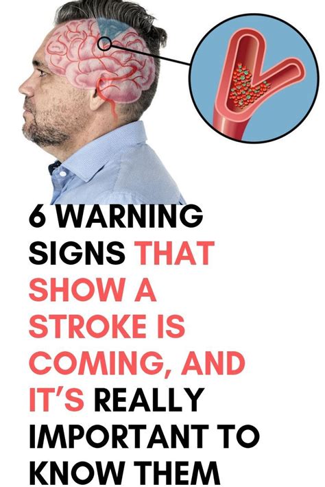 6 Warning Signs That Show A Stroke Is Coming And Its Really Important