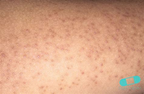 Online Dermatology How To Treat The Red Bumps On Your Arms