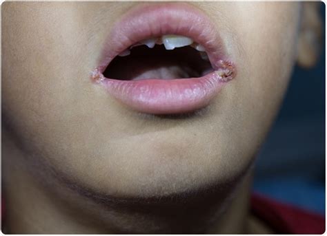 What Is Angular Cheilitis