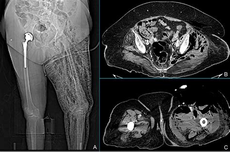 Total Body X Ray Shows Marked Left Leg Emphysema A Ct Scan Of The