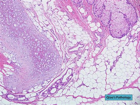 Qiaos Pathology Ovarian Dermoid Cyst Mature Cystic Teratoma A