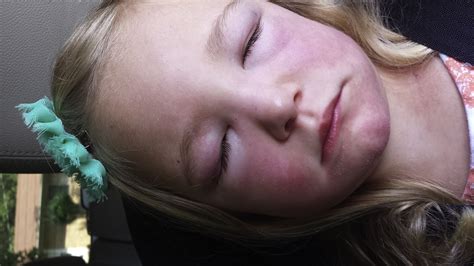 Heliotrope Rash And Gottron Papules In A Child With Juvenile