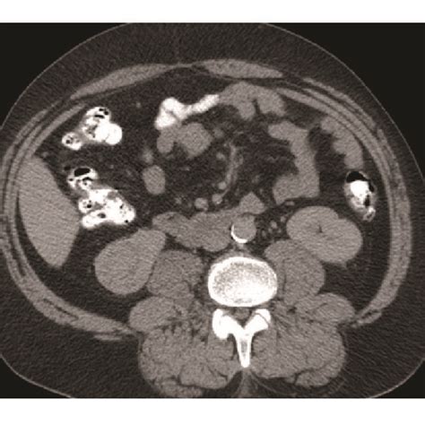 Axial Image Showing Right Kidney Lower Pole 4 Cm Renal Mass With