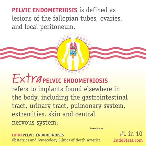 Extrapelvic Endometriosis Endometriosis Endometriosis Awareness