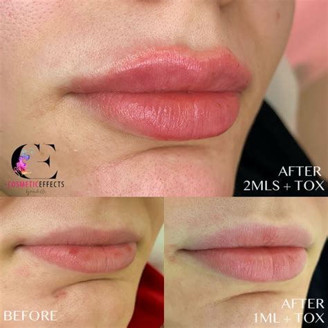 Achieve A Smooth Chin And Diminish Creases With Botox