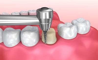 Dental crowns can be an expensive procedure without insurance. Visit a Restorative Dentist in Dunwoody for Dental Crowns - Plunkett & Chaw Dental Dunwoody Georgia
