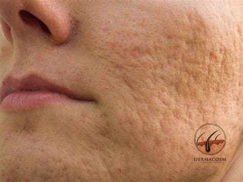 How To Reduce An Atrophic Acne Scar Dermacosm