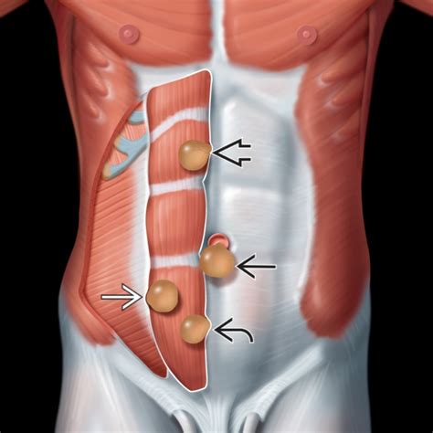 Hernias Pared Abdominal Hernia Inguinal Hernia Femoral The Best Porn