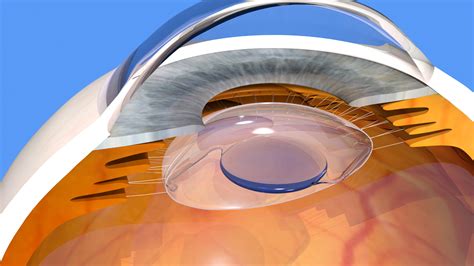 Multifocal Iol Intraocular Lenses Pros And Cons Prices And Success Rate