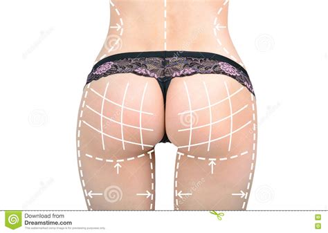 Marks On The Women S Buttocks Waist And Legs Before Plastic Surgery