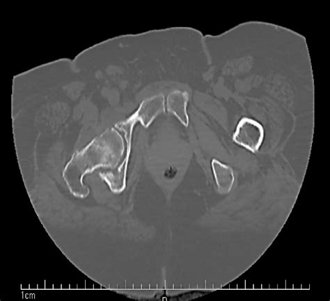 A Axial Ct Scan Of The Pelvis Without Contrast Advanced Degenerative
