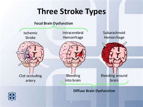 Types Of Strokes 2013stroke Areyouready Nurse Teaching Stroke