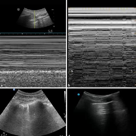 Sonographic Findings To Confirm Or Rule Out Pneumothorax In The Study