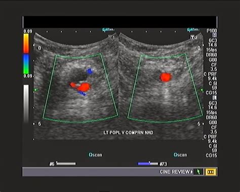Ultrasound Imaging A Patient Of Calf And Leg Pain Venous Doppler Study My XXX Hot Girl