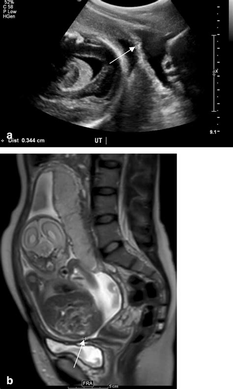 Uterine Perforation And Associated Peri Uterine And Pelvic Abscess In A