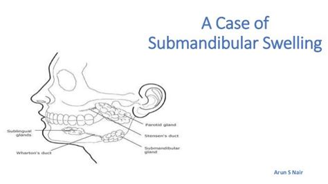 A Case Of Submandibular Swelling