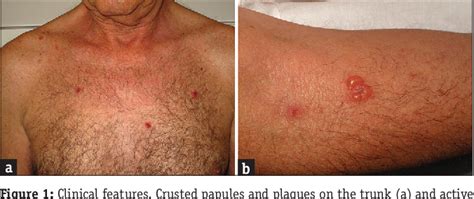 Nivolumab Induced Bullous Pemphigoid Managed Without Drug Withdrawal