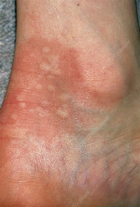 Urticaria Rash Hives On Ankle Due To Nettles Stock Image M280