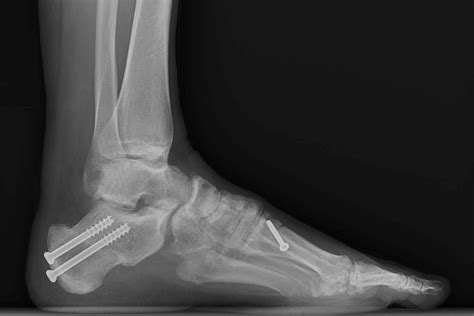 High Arch Foot — Daniel Bohl Md Midwest Orthopaedics At Rush