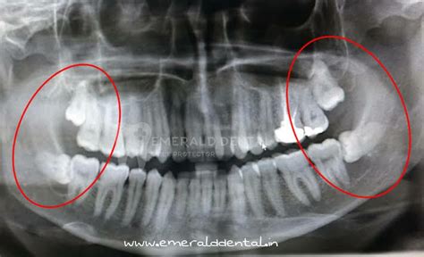 What Is A Dentigerous Cyst Emerald Dental