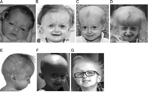 Hutchinson Gilford Progeria Syndrome