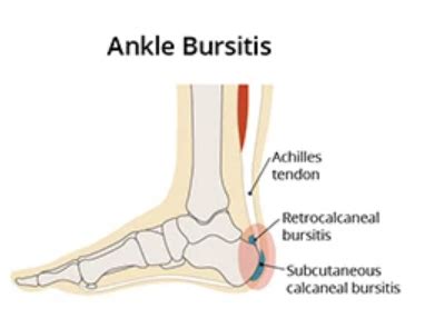 Bursitis In The Foot Back In Action Physio Injury Information