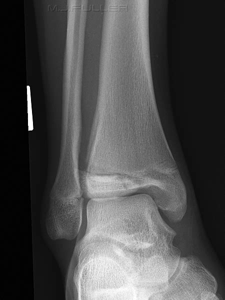 Ankle Trauma 3 Wikiradiography