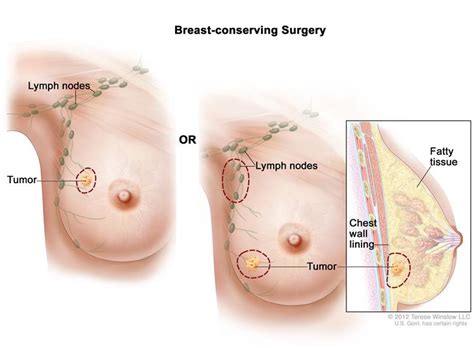When i feel the breast i don't feel lumps, but in the armpit i feel what i think might be a lymph node, but not sure because i tend to have lumpiness, so not sure if i am over reacting to something that has been there all a long. Breast Cancer Treatment (PDQ®)—Patient Version - National ...