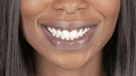 What Causes Black Gums Stanley Dentistry