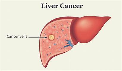 Liver Cancer Surgery Points