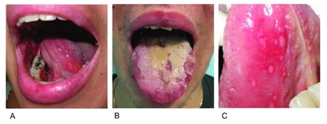 Oral Ulcers In Patients With Behçets Disease A A Centimetric