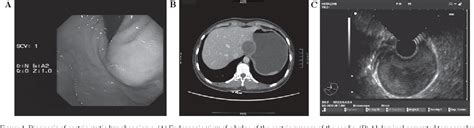 Figure 1 From Giant Cystic Lymphangioma Originating From The Cardia Of